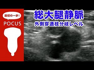 総大腿静脈（外側穿通枝レベル）【POCUS・ポイントオブケア超音波】