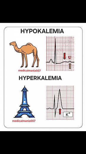 ECG Interpretation :-- HYPOKALEMIA V/S HYPERKALEMIA #ecg #ecginterpretation #ecgreading #ecgchallenge #medicos #medico #medical #medicalstudents #medicalscience #mbbsstudent #mbbs #mbbsdiaries #nursing #nursingstudent #viral #tranding #neetpg #neet #fmge | medicalmania007
