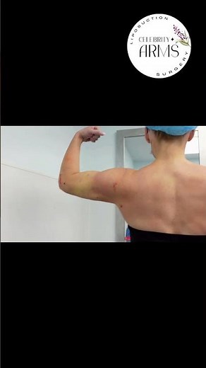 360° Arm Liposuction | Celebrity Arms™ | Immediate Results | Expert Dr. Thomas Su | Artlipo