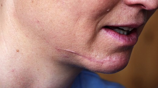 Narbenbehandlung: Was hilft wirklich gegen störende Narben?