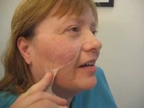 How to fill in acne scars instantly!