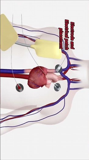 cardioversion procedure in 3D, restore normal heart rhythm,life saving heart procedure ❤️