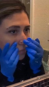 My favorite watch 🤤 | Pimple Popping