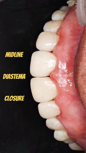 Importance of diagnostic wax-up before midline diastema closure.