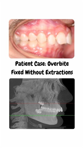 Many patients are told severe overbites require teeth removal or even jaw surgery. In this patient’s treatment, we corrected a deep overbite by utilizing the jaws growth and carefully repositioning the teeth and balancing the bite, while keeping every natural tooth. 🦷 👉 Book a FREE consultation through the link in bio. #Orthodontics #BracesTreatment #OverbiteCorrection #VirginiaParents #NorthernVirginia