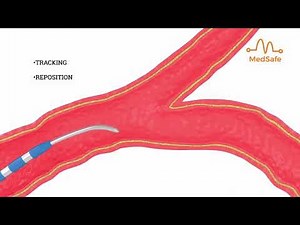 4 3 3F Guidewire Tip Catheter