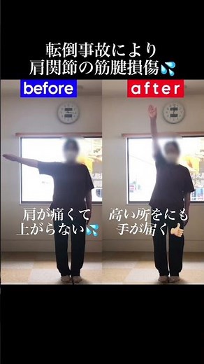 肩関節痛で腕が上がらない患者様【兼子ただし】神経系ストレッチで改善解消