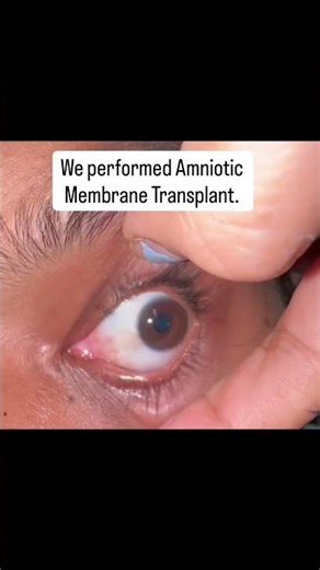 Chemical injury in eye in plastic factory healed after Amniotic membrane grafting