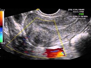 MIOMA INTRAMURAL QUE COMPROMETE ENDOMETRIO