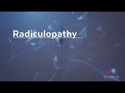 Radiculopathy - Patient Animation