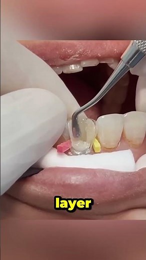 Amazing Tooth Reconstruction! 🦷✨ #Dentistry #shorts