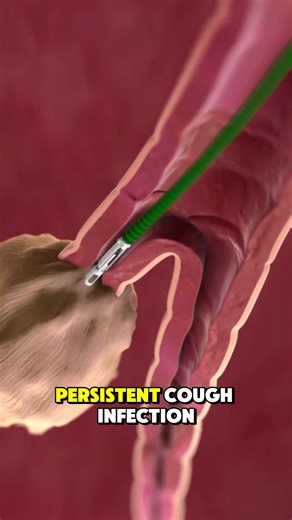 How Bronchoscopy Procedure Explained | 3D Animation #Bronchoscopy #BronchoscopyProcedure #MedicalWorld3D #KNP3DAnimation #LungExamination