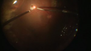 Scleral Buckle and Vitrectomy - Eyetube