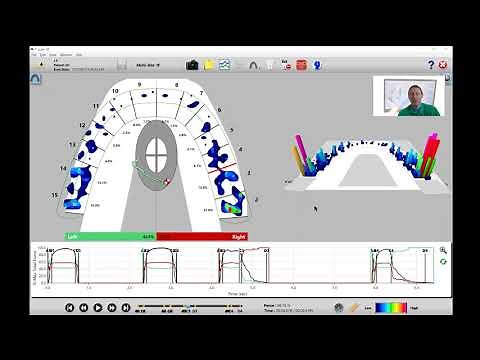 How to Analyze a Lateral or Excursive Movement in T-Scan Software