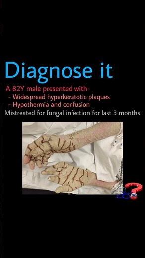 Crusted/Norwegian Scabies #scabies #crustedscabies #Norwegianscabies #mites #sepsis