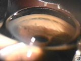 Indentation Gonioscopy with Peripheral Anterior Synechiae - Eyetube