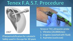 Demo Of Less-Invasive FAST Tennis Elbow Surgery Procedure