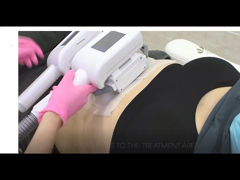Fat Freezing treatment before and after with Dr Leah