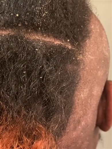 6.3K views · 22 reactions | Dandruff asmr scratching removal on head using combing | Entertainment | Facebook