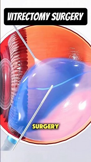 Vitrectomy Surgery for Retinal Repair|How Vitrectomy Eye Surgery Works #vitrectomy #retina #retinal
