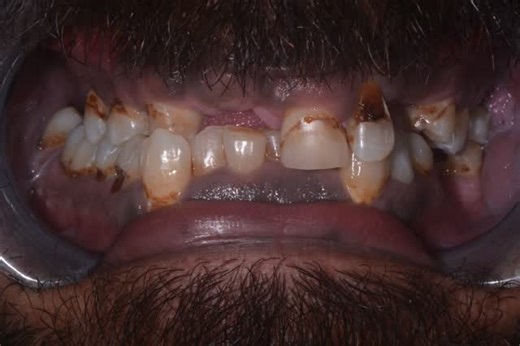 Burke Implant Academy on Instagram: "A big part of doing arches is maintaining them. Here is a 2 year follow up: Some literature says you shouldn’t remove hybrids for cleaning—I respectfully disagree. Even with perfect AP spread, ideal occlusion, and a restored smile, we must remember our patients arrived with terminal dentition, parafunction, wear, and often periodontal disease. Restoring function doesn’t eliminate risk. In @oralaestheticsandimplants , and at the Burke Implant Academy—we teach 