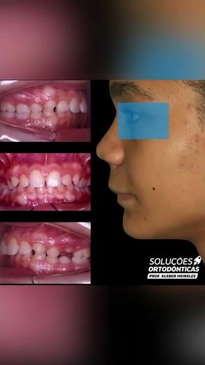 BIONATOR - ORTHODONTIC TIPS #Shorts