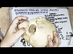 zygomatic bone fracture symptoms
