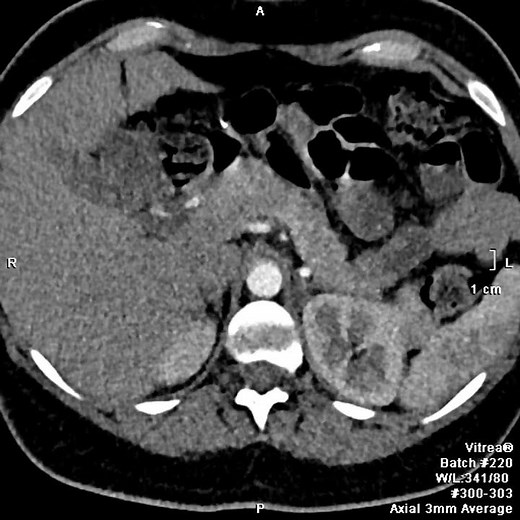 CTA aorta with total IV contrast of 20 ml