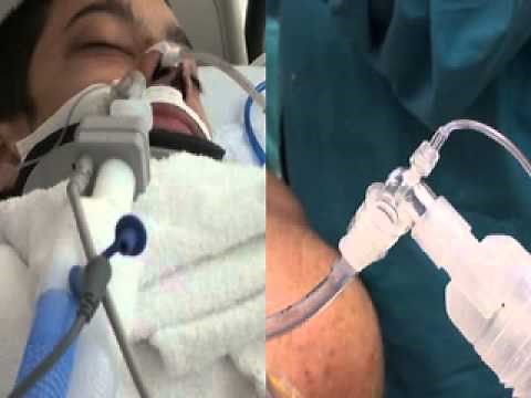 Monitoring Ventilation with Capnography NEJM