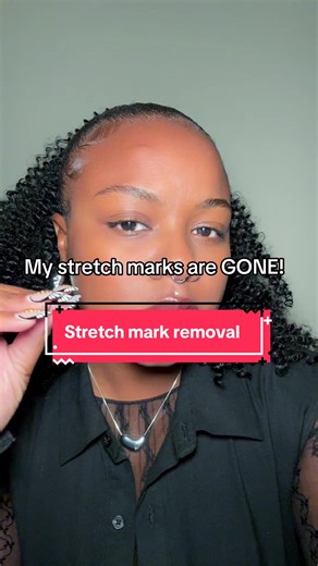 Effective Stretch Mark Removal Techniques You Should Know