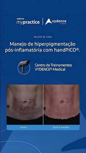 Antes e depois: manejo de hiperpigmentação pós-inflamatória (HPI)