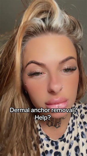 Dermal Anchor Removal: Essential Tips and Guide