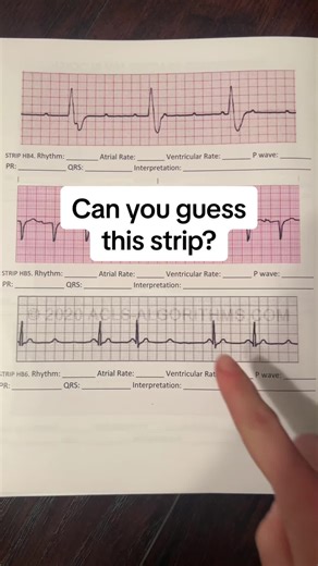 Did you guess this heart block correct? Heart blocks are more on the trickier end to interpret and it is where many people become confused. I hope this helps! #ekg #ecg #ekginterpretation