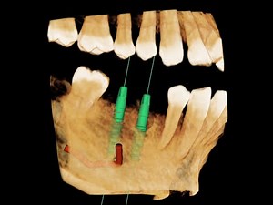 Dental Implant in Close proximity of Mental Foramen