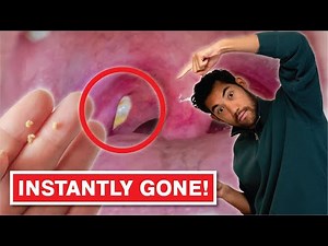 What are Tonsil Stones? | How to PREVENT and Remove them for GOOD!