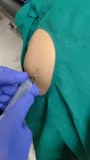 trigger point inj for knee pain instant releif.