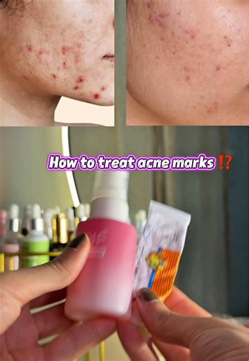 How we can treat acne marks , dark spots , pigmentation around mouth and dullness. With these two products @JENPHARM Maxdiff brightening serum (code Asma5) . . . . . #acnemarks #darkspots #darkspotserum #viral #whitening