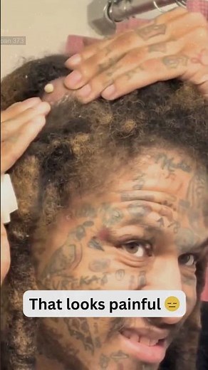 Deep Blackheads, Milia & Whitehead Removal pimple popping New| Big Cystic Acne Extraction #1157 2026