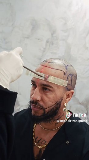 Mr. Monteiro's Hair Transplant Journey at Sule Clinic