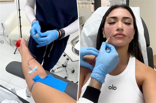 ‘Next gen’ filler craze uses your own blood — but docs warn it is ‘unreliable’
