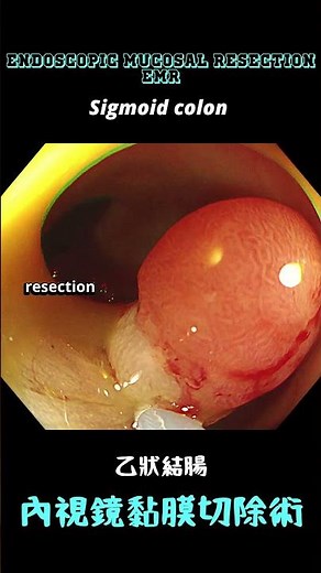 內視鏡黏膜切除術(Endoscopic mucosal resection, EMR)
