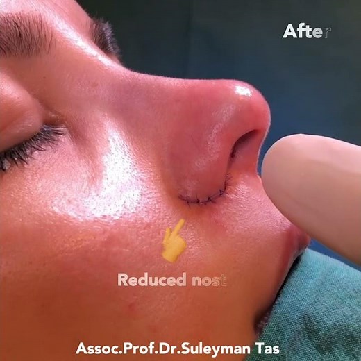 Nostril Reduction Surgery Before After