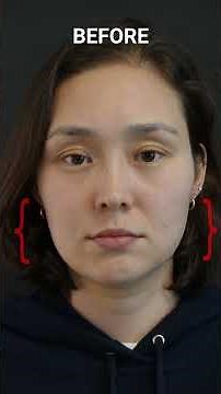 WATCH THIS INSANE LIP LIFT, CORNER LIP LIFT AND CHIN IMPLANT TRANSFORMATION !