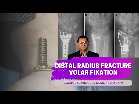 Distal Radius Fracture | Volar Fixation