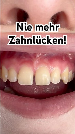 Mit der FLOWABLE Injection Technique!!! #flowableinjection #zahnlücke #schönezähne