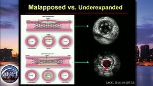 Introduction to Coronary IVUS
