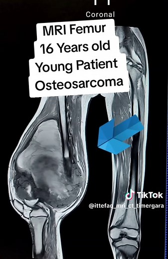 MRI of Femur Showing Osteosarcoma in Young Patient