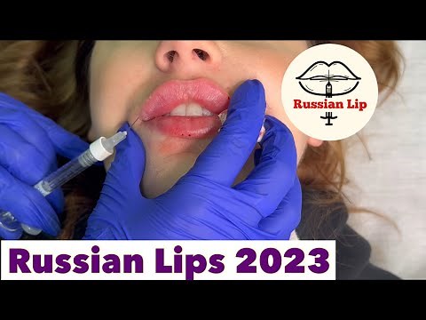Russian Lips - How to inject Lip Filler