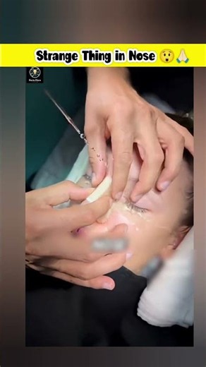 What is Nasal Splint? #facts #ytshorts #shorts