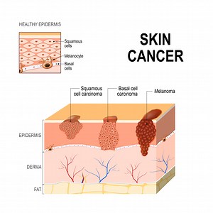 Melanoma Explained
